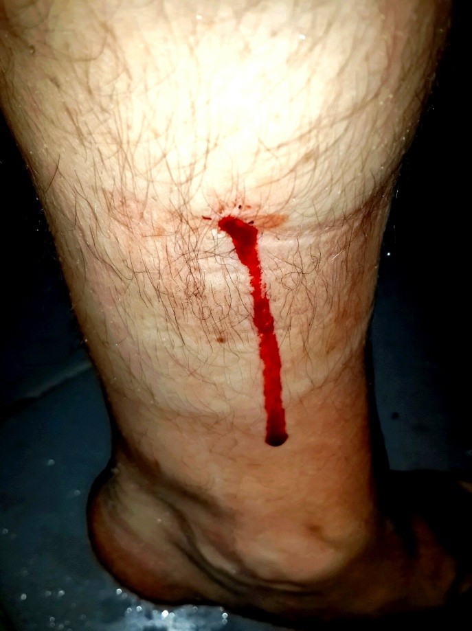 Trip photo #19/19 Aftermath of a leech attack.